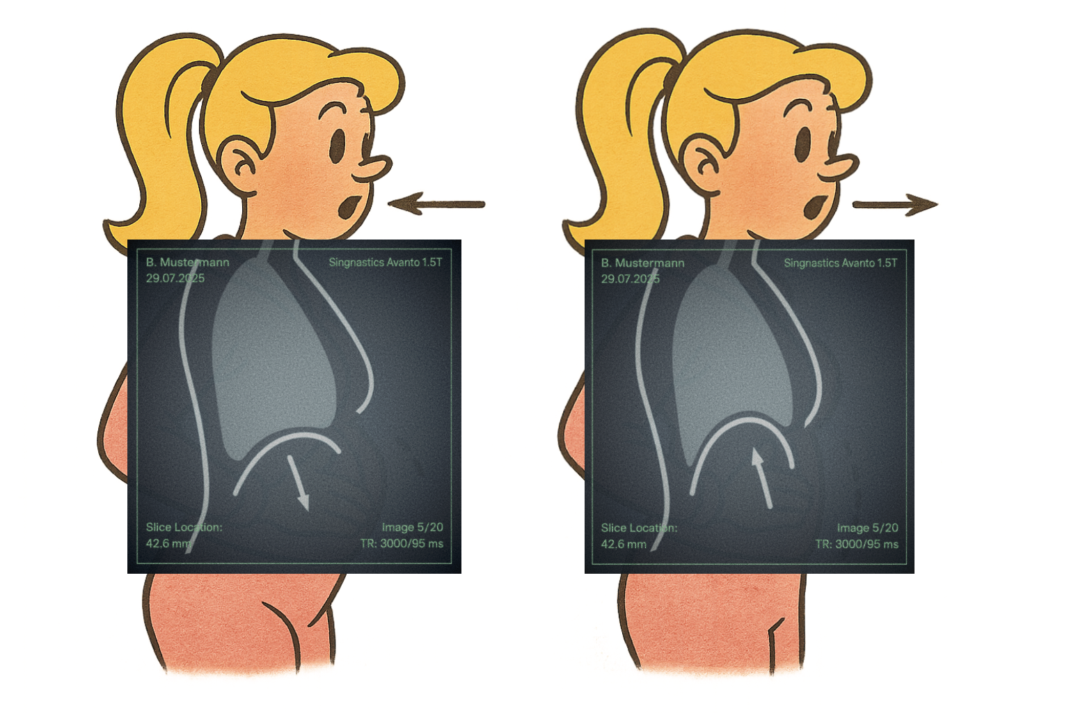 Retro-Zeichnung einer Frau mit MRT-Overlays bei der Atmung: links beim Einatmen mit abgesenktem Zwerchfell, rechts beim Ausatmen mit angehobenem Zwerchfell. Pfeile zeigen Atemrichtung.